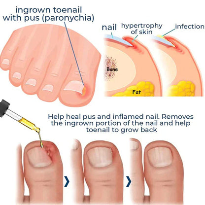 German ToenailPlus™ Anti Paronychia Relief Oil